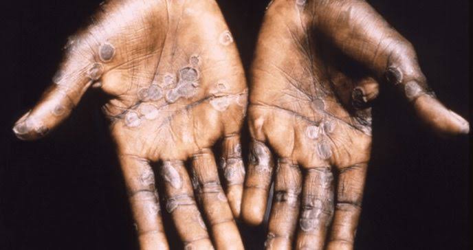 Imagen de unas manos mostrando la infeccion de la viruela símica