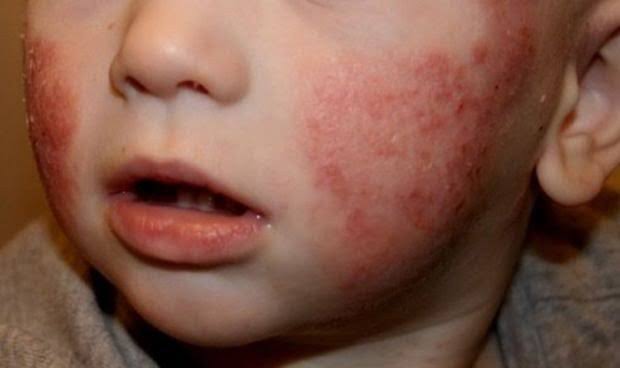 Imagen de un niño con alergia en su rostro